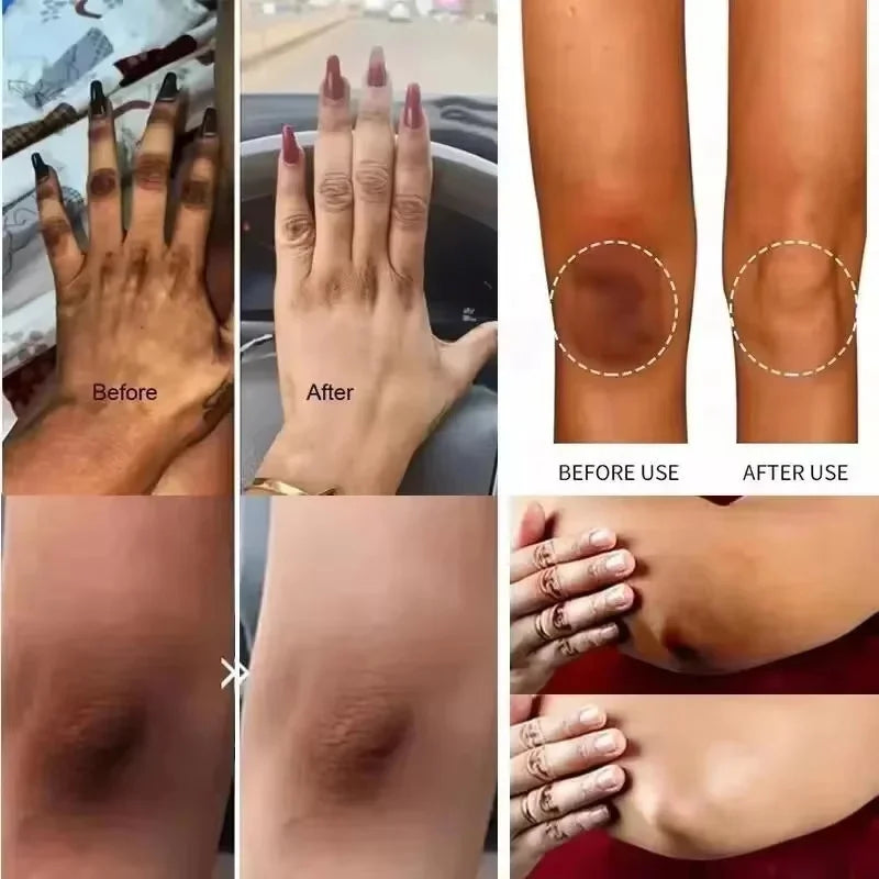 Crème éclaircissante pour le corps, peau foncée, aisselles, zones intimes, blanchiment des parties intimes, lotion corporelle, beauté