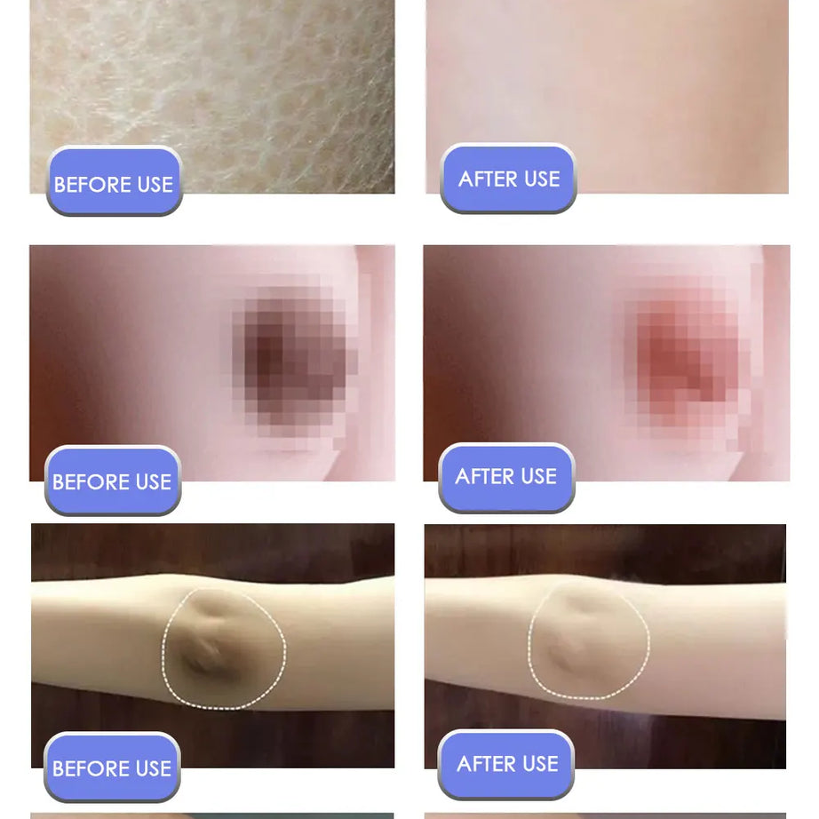Crema blanqueadora corporal para partes íntimas, suero blanqueador para axilas, blanquea glúteos, rodillas, ilumina la parte interna del muslo, piel oscura íntima, elimina la melanina.