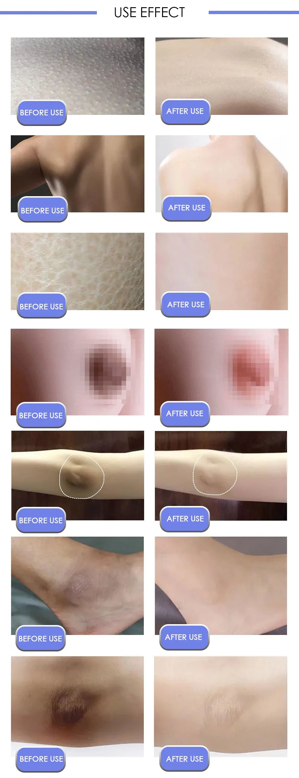 Crema blanqueadora corporal para partes íntimas, suero blanqueador para axilas, blanquea glúteos, rodillas, ilumina la parte interna del muslo, piel oscura íntima, elimina la melanina.