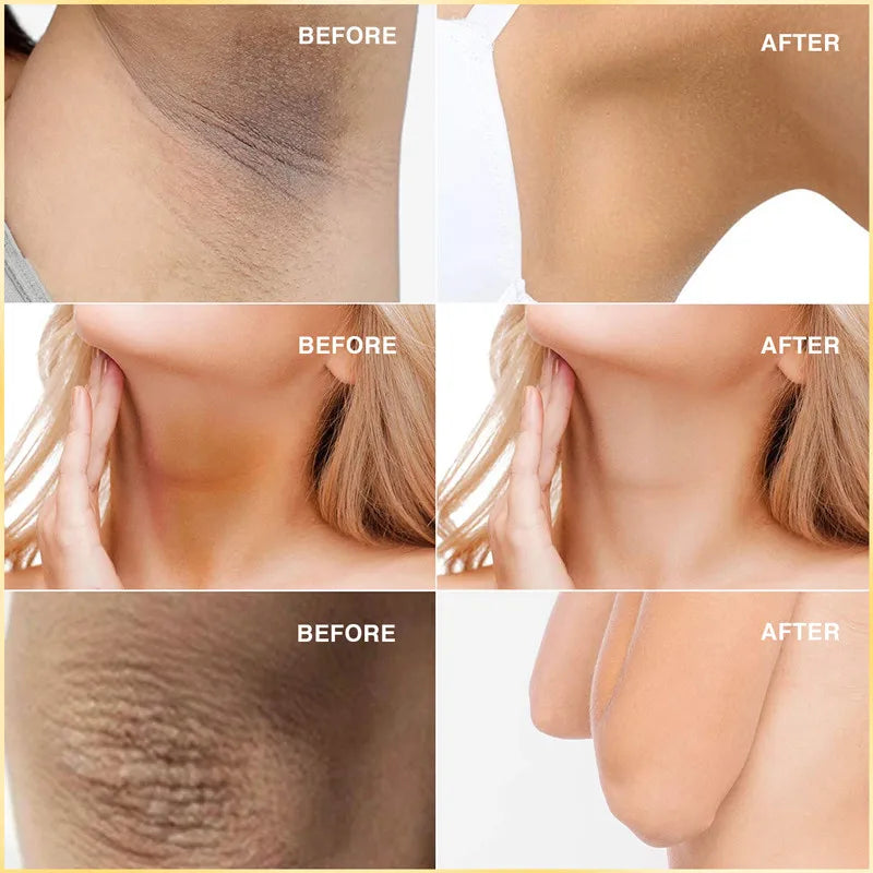 Crema blanqueadora corporal para partes íntimas, suero blanqueador para axilas, blanquea glúteos, rodillas, ilumina la parte interna del muslo, piel oscura íntima, elimina la melanina.