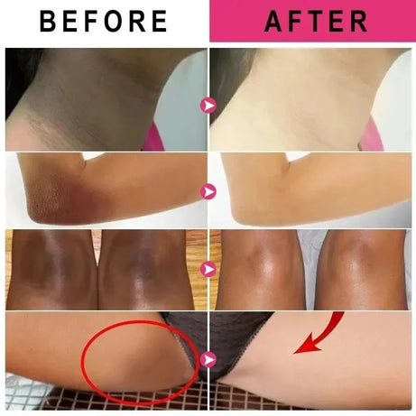 Body Whitening Cream Dark Skin Armpit Lightening Intimate Areas Underarm Bleaching Private Parts Whiten Cream Body Lotion Beauty