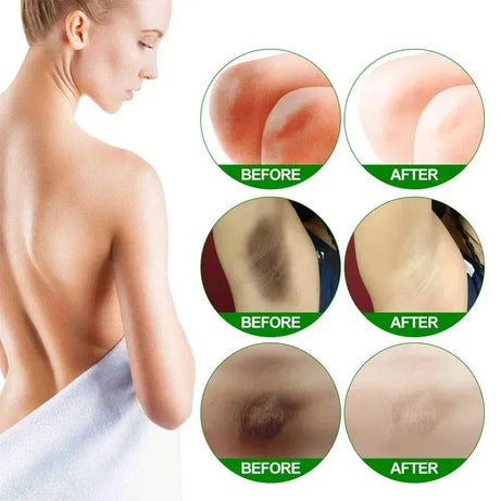 Body Whitening Cream Dark Skin Armpit Lightening Intimate Areas Underarm Bleaching Private Parts Whiten Cream Body Lotion Beauty